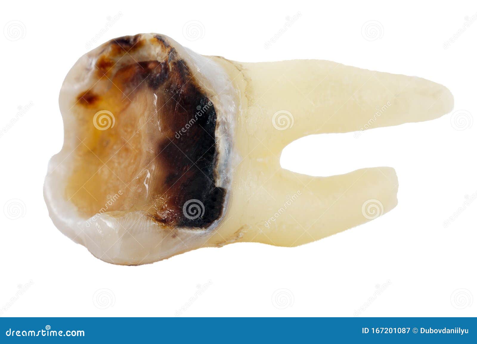 Extracted caries tooth stock image. Image of dirty, dentistry 167201087