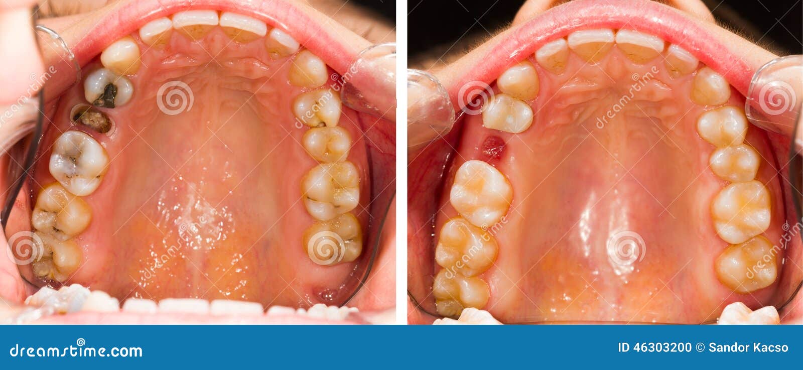 Extraction Et Résine De Dent Photo stock Image du bactéries, closeup