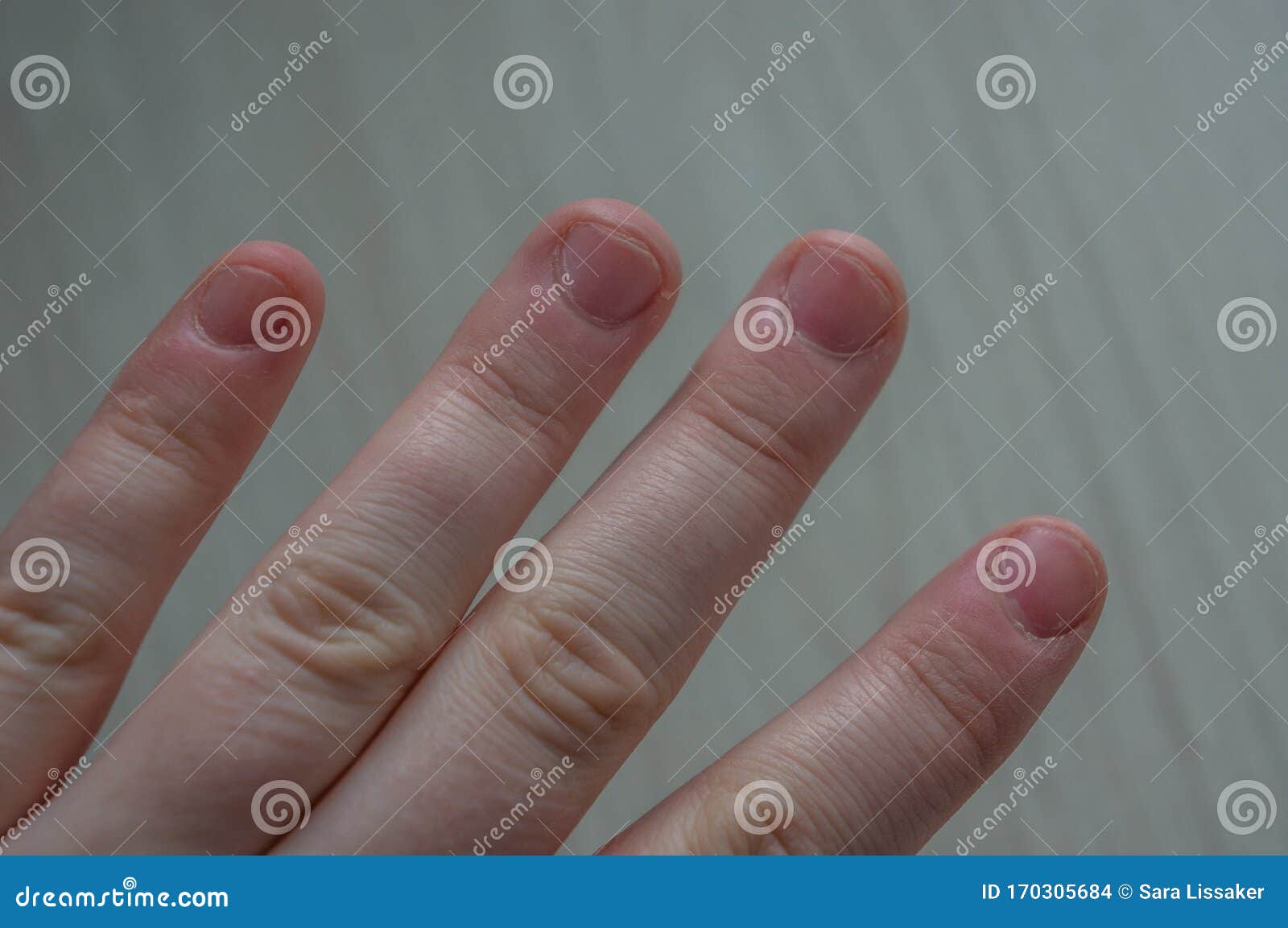 Extremely Damaged Finger Nails with Swollen Cuticles from Nail Biting Due  To Anxiety and Compulsive Disorder. Conceptual Image Stock Photo - Image of  condition, deformed: 170305684