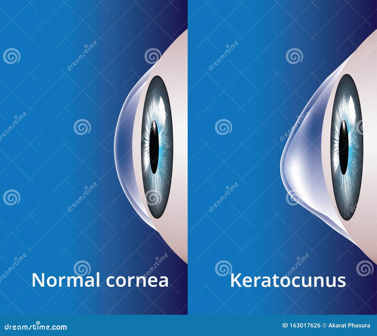 Eye Cornea And Keratoconus, Eye Disorder, Medical Vector