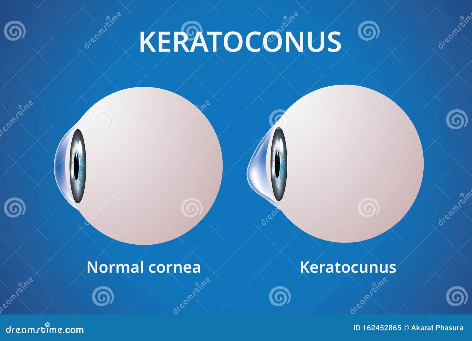 eye cornea and keratoconus, eye disorder, medical 