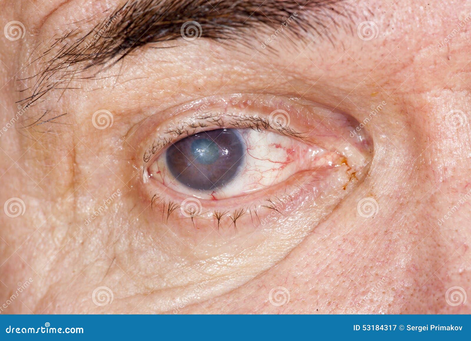 Eye disease stock image. Image of optometry, retina, ophthalmology