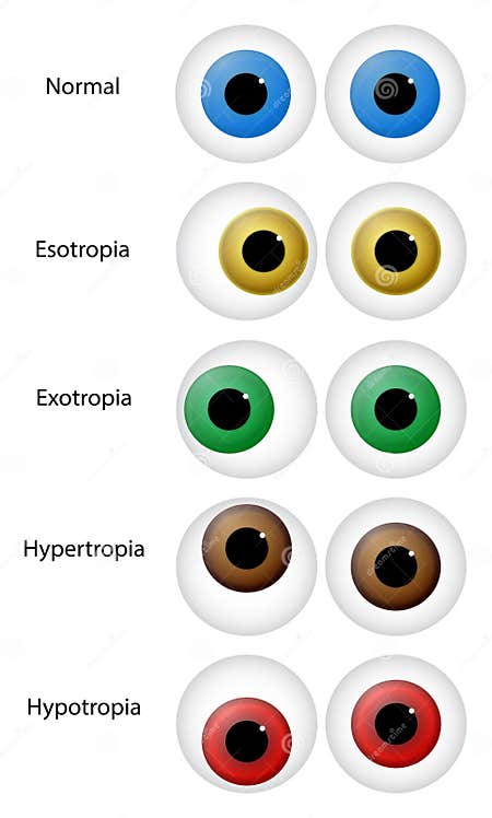 Eye Disorders stock vector. Illustration of aiming, esotropia - 29146584