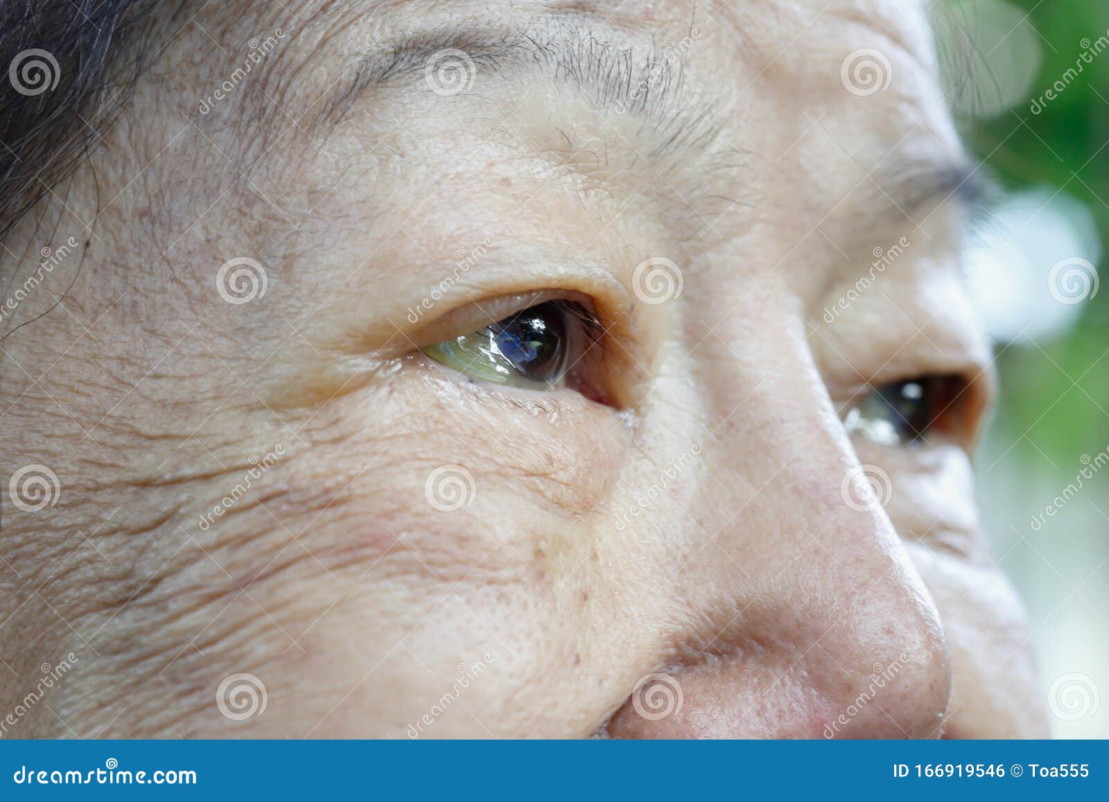 Eye edema in elderly woman stock photo. Image of puffy 166919546
