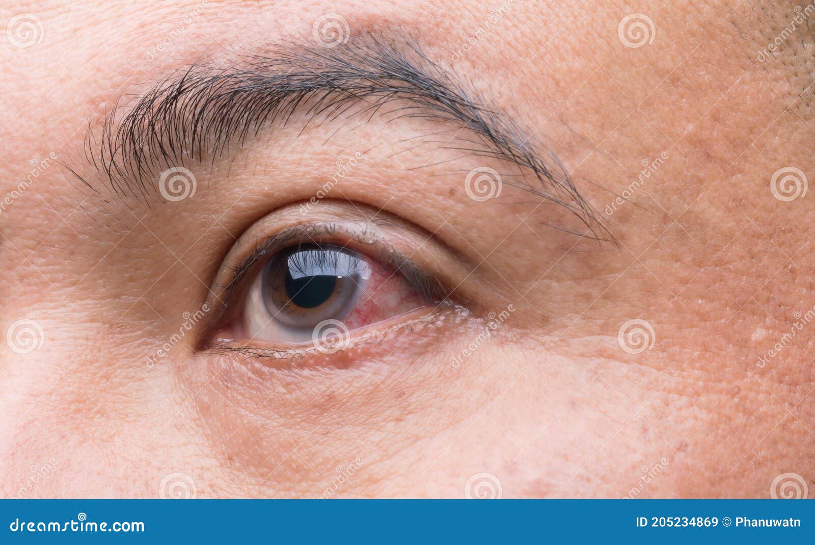 Eye Irritation Concept Red Eye of Man, Conjunctivitis Eye or after