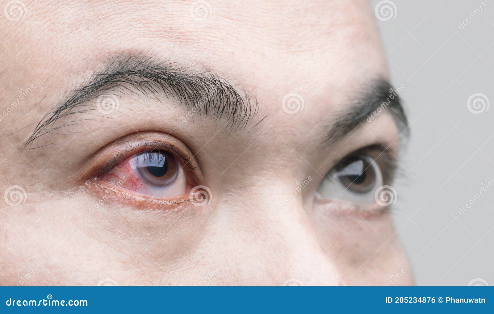 Eye Irritation Concept Red Eye of Man, Conjunctivitis Eye or after