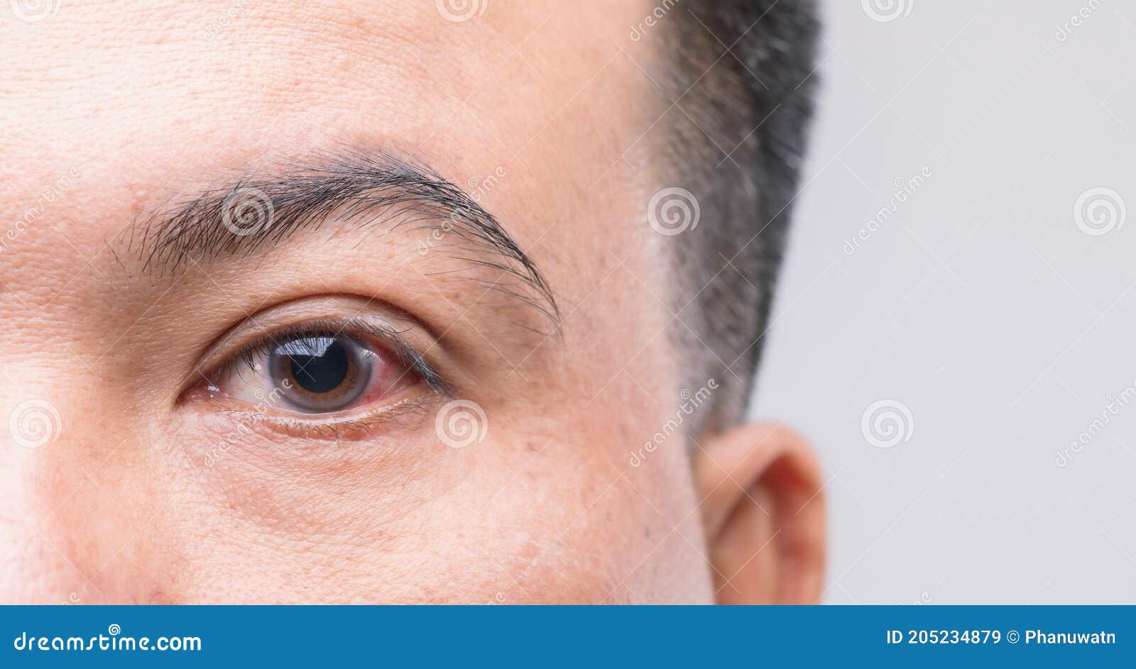 Eye Irritation Concept Red Eye of Man, Conjunctivitis Eye or after