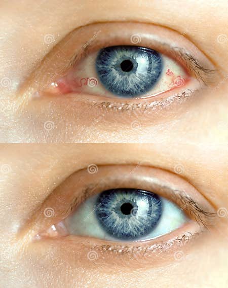 Eye before and after Treatment Stock Photo – Image of doctor, hospital …