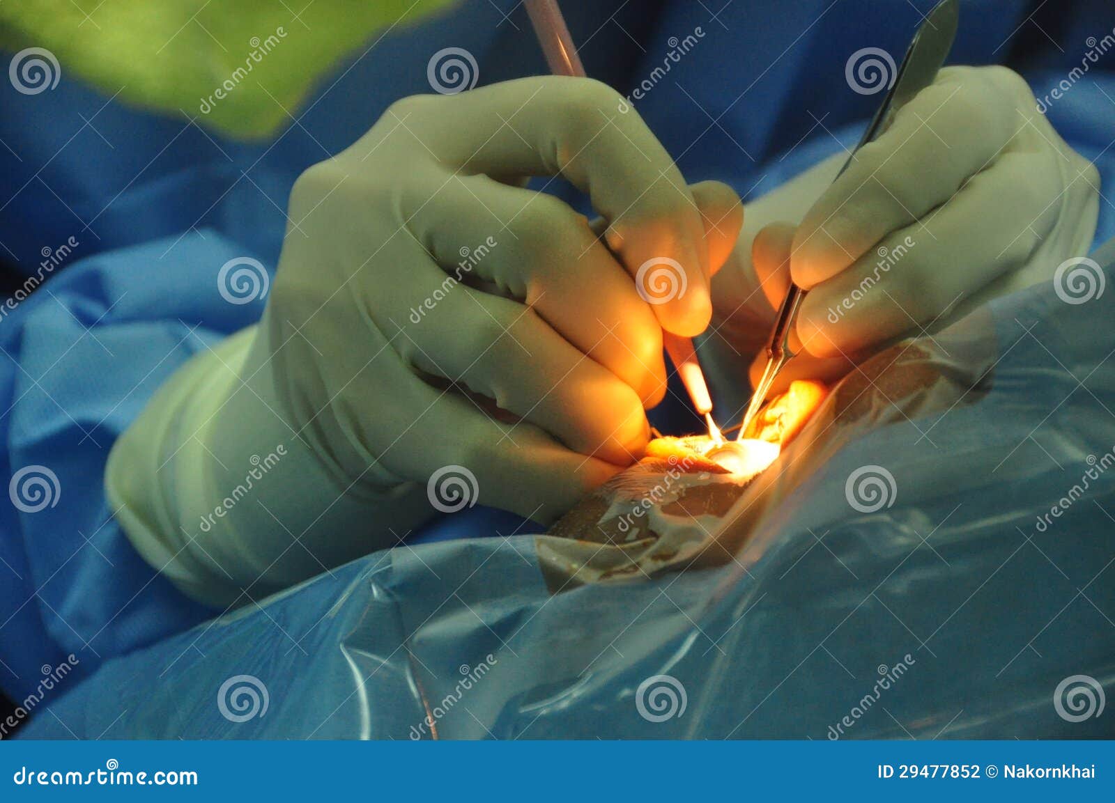 Eye Surgery Cataract Stock Photography Image 29477852