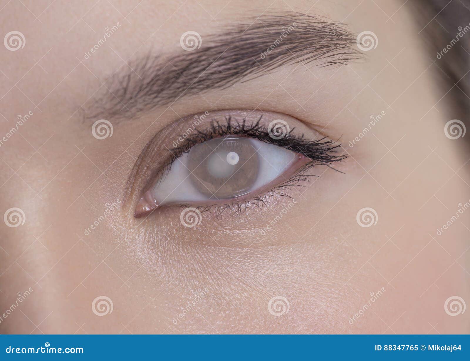 eye of a woman with cataract