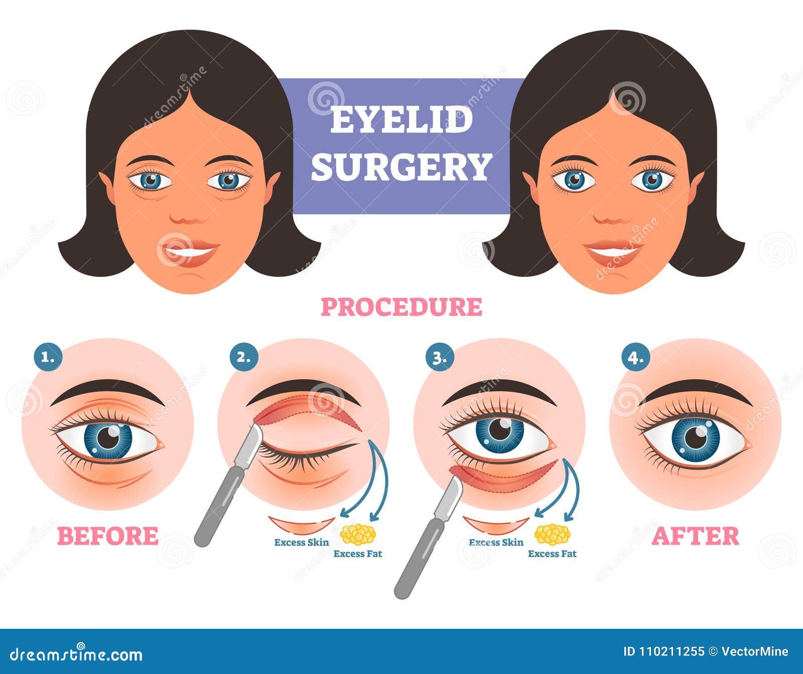 eyelid surgery procedure before after illuatration with main steps. excess skin and fat removal.