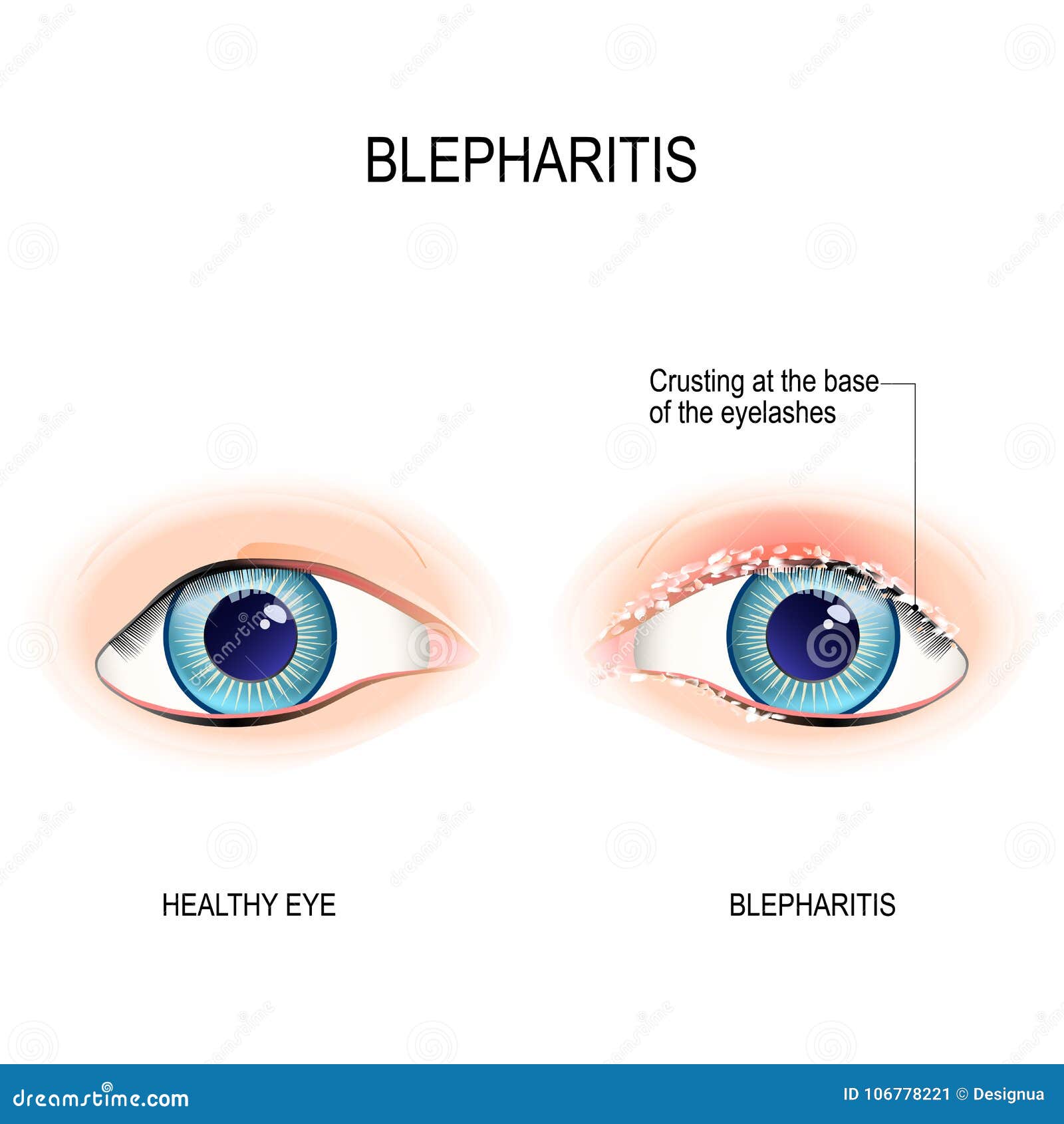 eyes of human. blepharitis. crusting at the eyelid margins