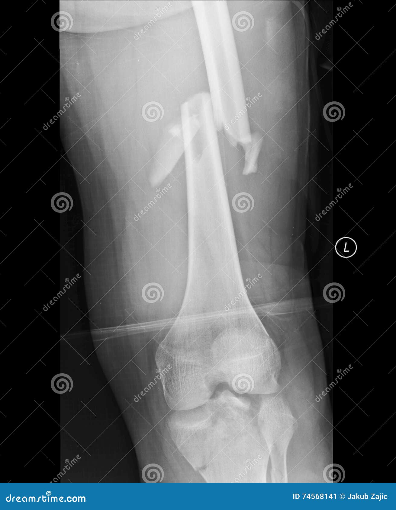 Image Aux Rayons X Du Fémur, Vue AP, Montrant Fracture Du Fémur Wiht Plaque  Commpression Osseuse Et Visser, Postoperatives. Banque D'Images et Photos  Libres De Droits. Image 43948983