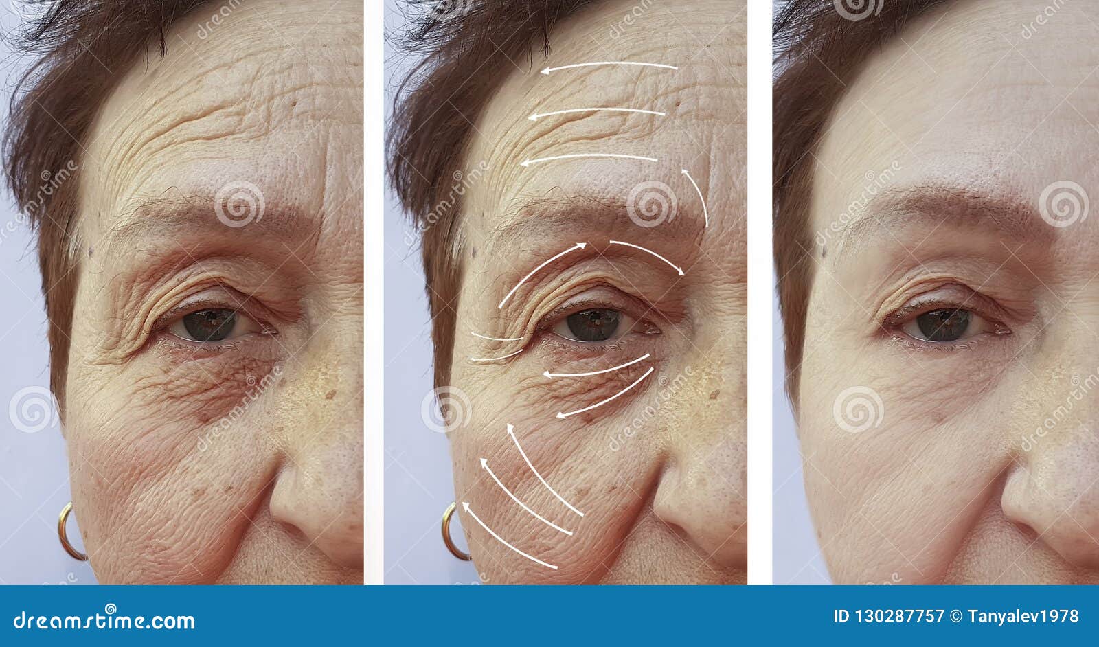 face, elderly woman, wrinkles, plastic filler difference patient contrast correction before and after procedures, arrow
