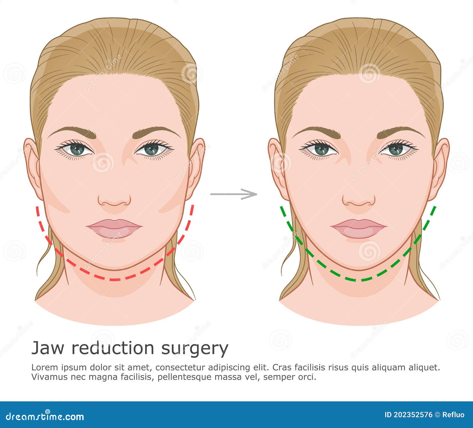 Face Europeia Da Cirurgia De Redução Da Mandíbula Ilustração do