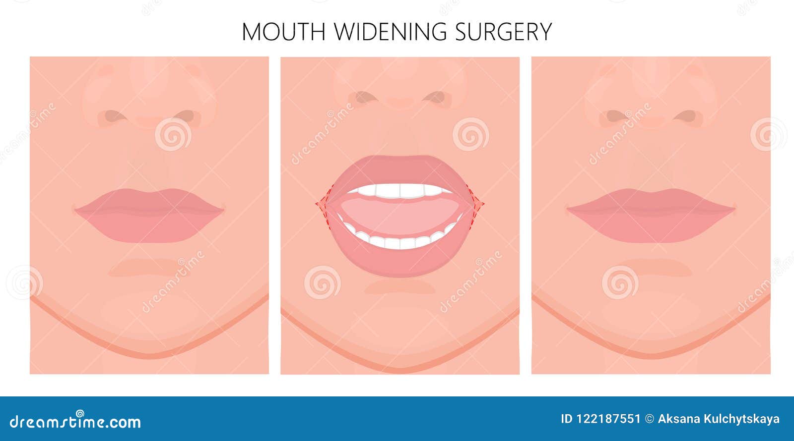 Face Front_Mouth Widening Surgery Stock Vector - Illustration of lower