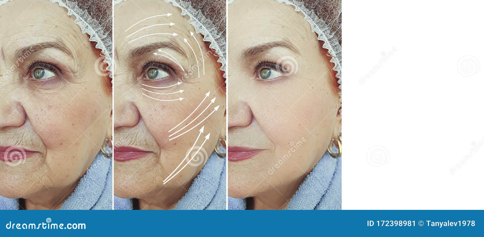 face old woman wrinkles before  after cosmetology  arrow plastic correction mature tension rejuvenation treatment