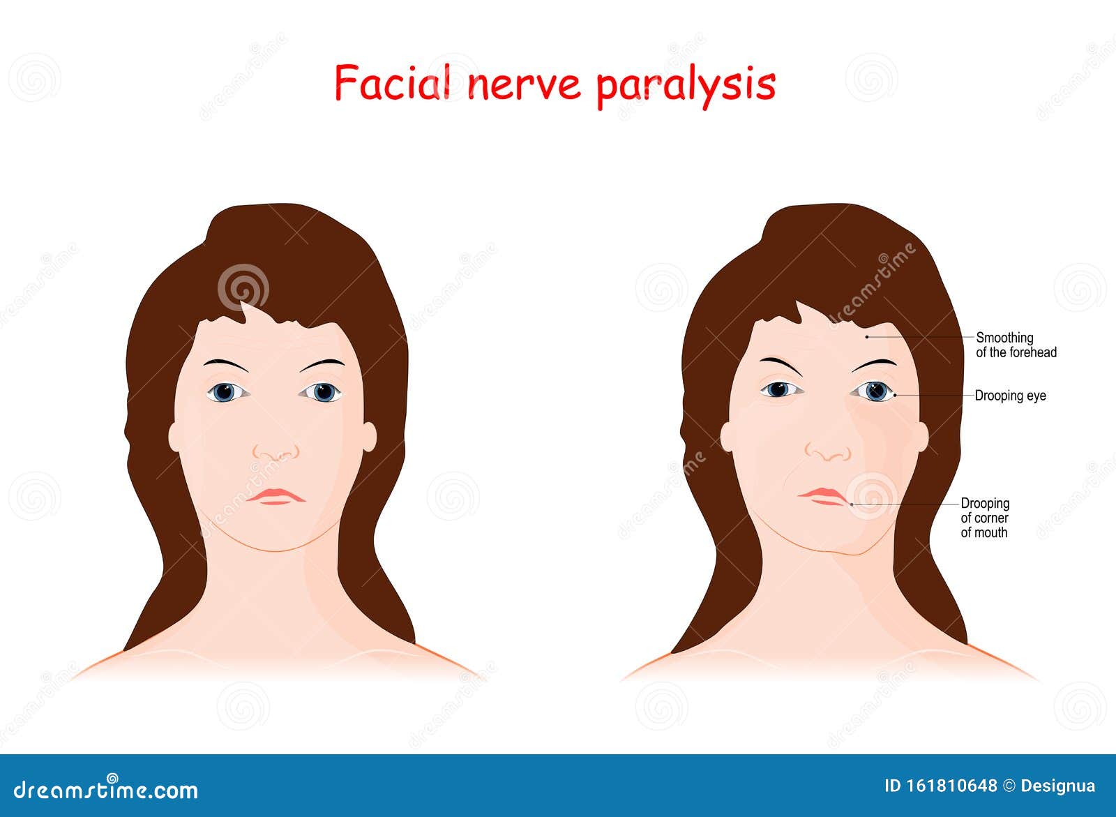 Facial Nerve Paralysis. Bell`s Palsy Stock Vector - Illustration of ...