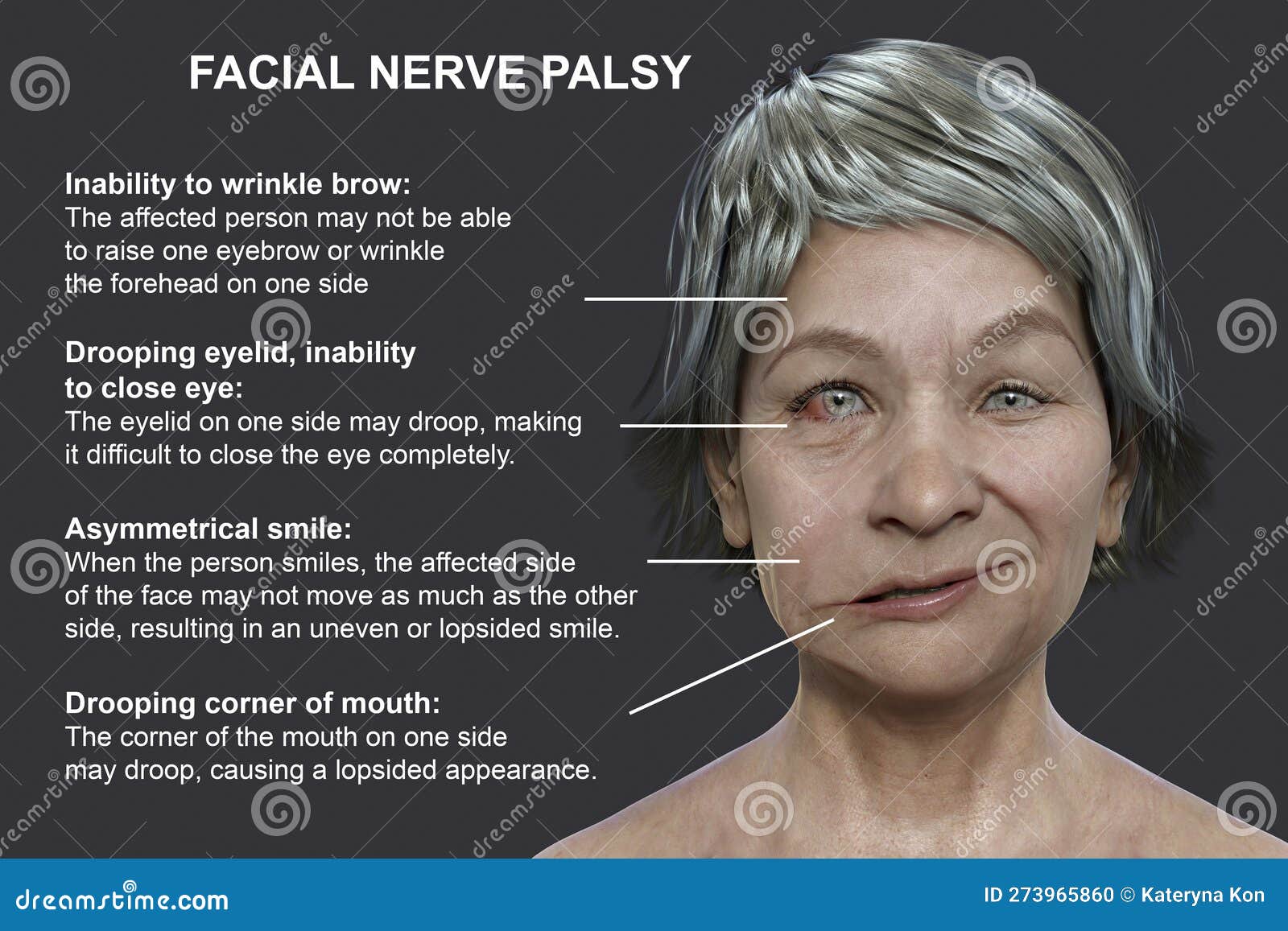 Facial Palsy In A Woman, 3D Illustration Highlighting The Asymmetry And ...