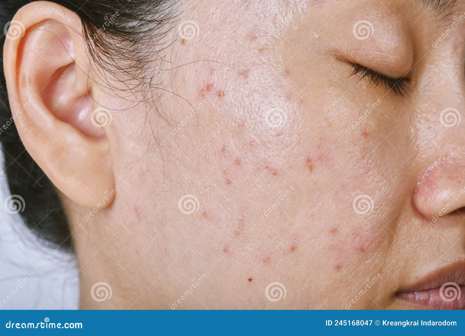 facial skin problem, acne disease in adult, close up woman face with whitehead pimples, oily greasy face