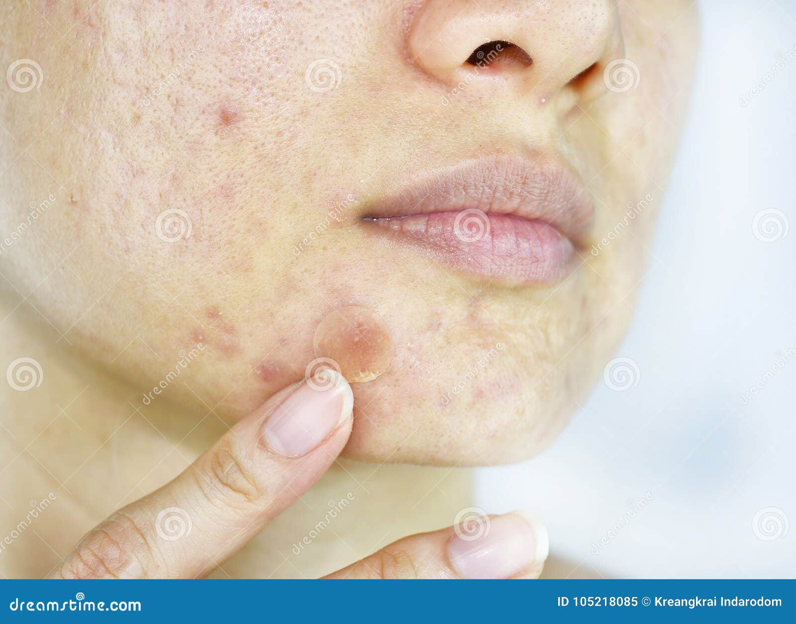 facial skin problem, close up woman face with whitehead pimples and acne patch