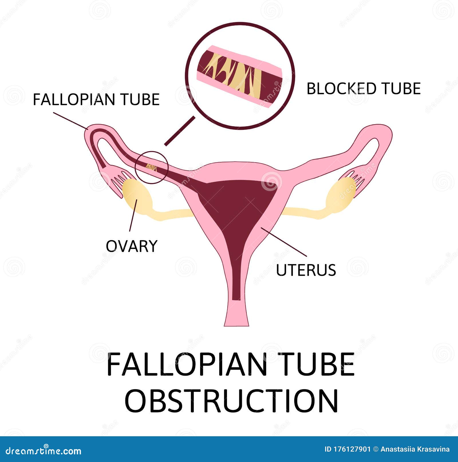  Fallopian Tube  Obstruction Or Blocked Fallopian  Tubes  