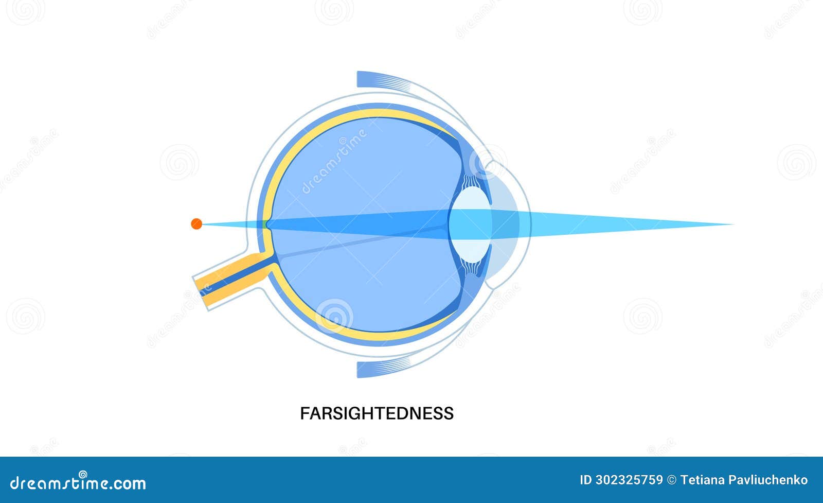 Farsightedness eye disease stock vector. Illustration of nerve 302325759