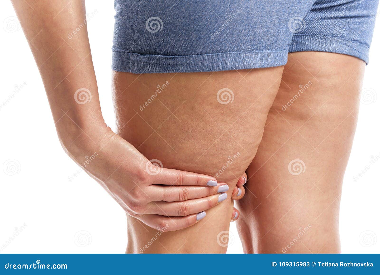 Fat And Cellulite On The Legs Stock Image Image Of Conscience