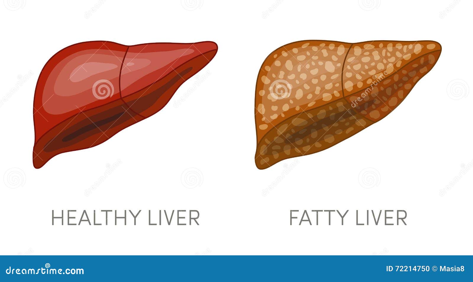 Fatty Liver Cartoon Stock Illustrations – 496 Fatty Liver Cartoon Stock Illustrations, Vectors & Clipart - Dreamstime Fatty Liver Cartoon Stock Illustrations – 496 Fatty Liver Cartoon Stock Illustrations, Vectors & Clipart - Dreamstime