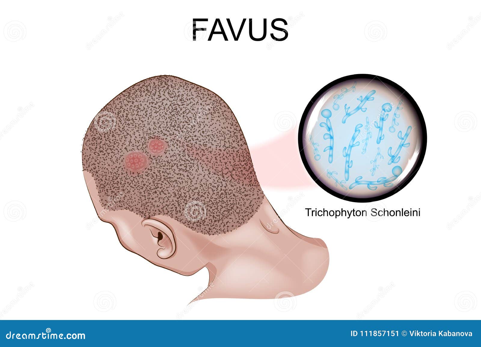 favus. the causative agent of favus