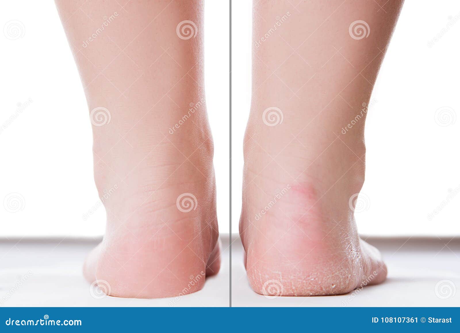 before after feet care concept, female foot, chiropody  on white background