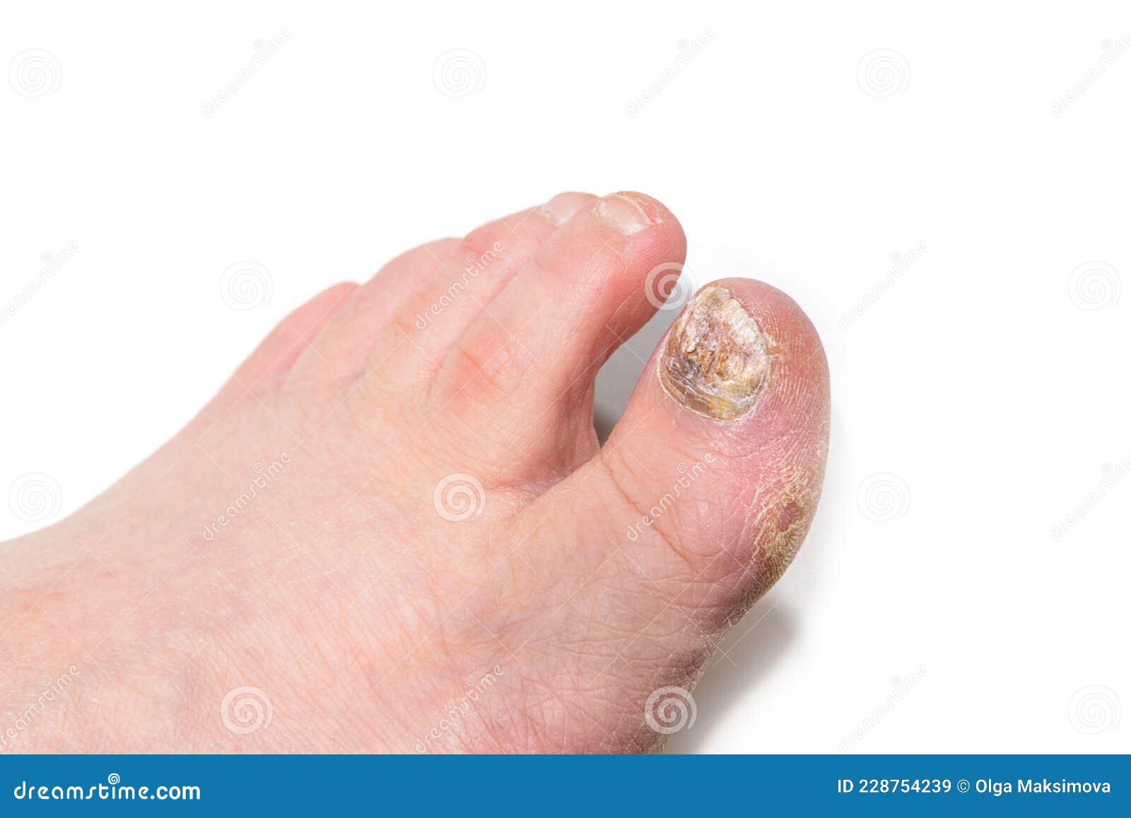 nail onichomicosis nail gombus kezelése