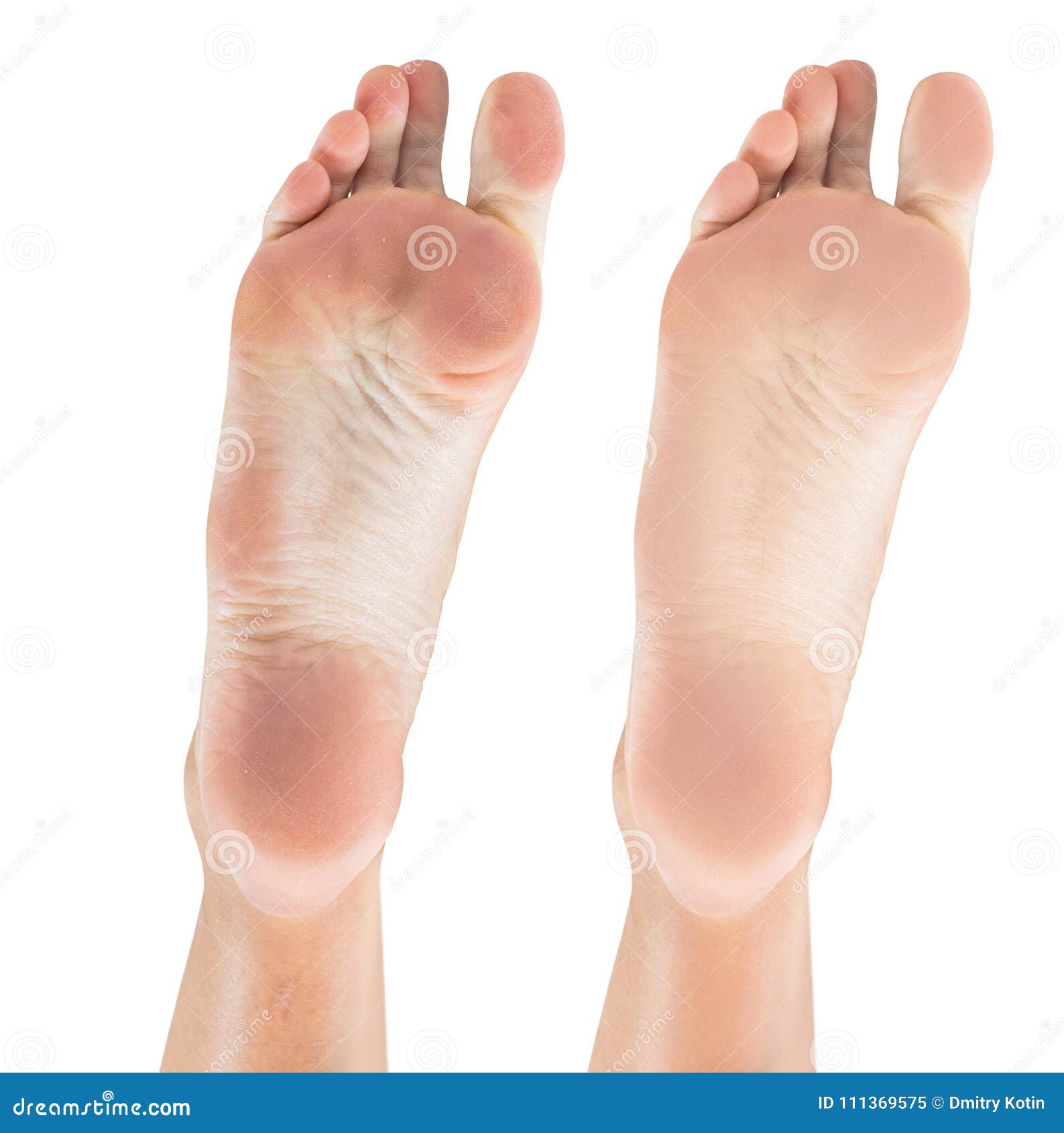 Feet With Dry Skin Before And After Treatment. Stock Image - Image of