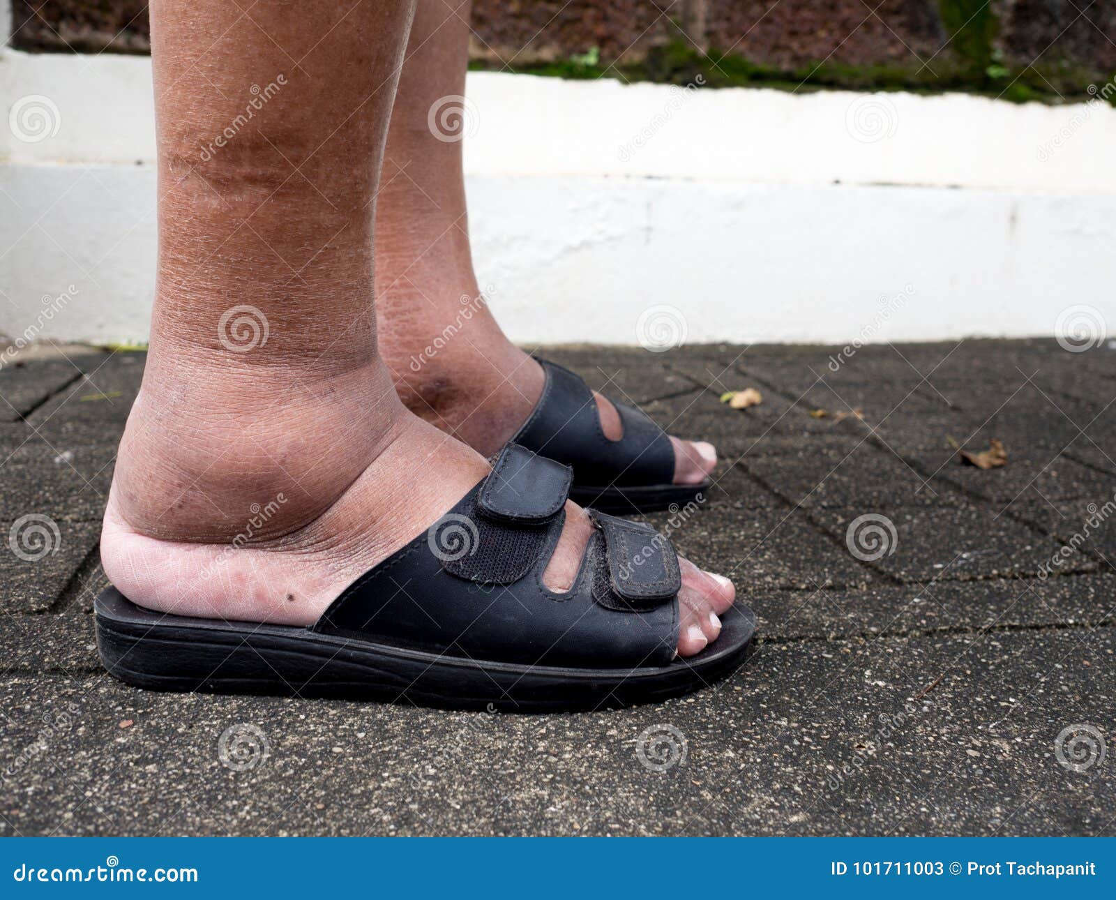 The Feet Of Man With Diabetes Dull And Swollen Due To The Toxicity Of