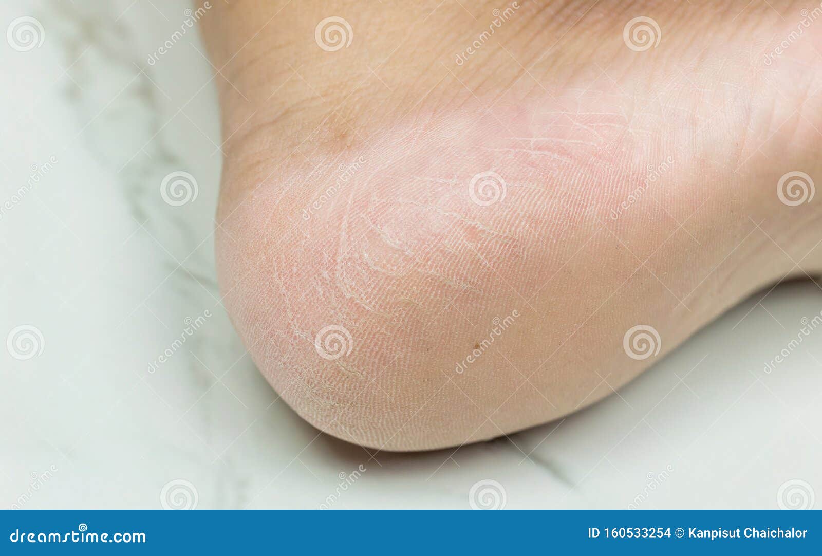 What is the Difference Between Gout vs Bunion? | The Bunion Cure