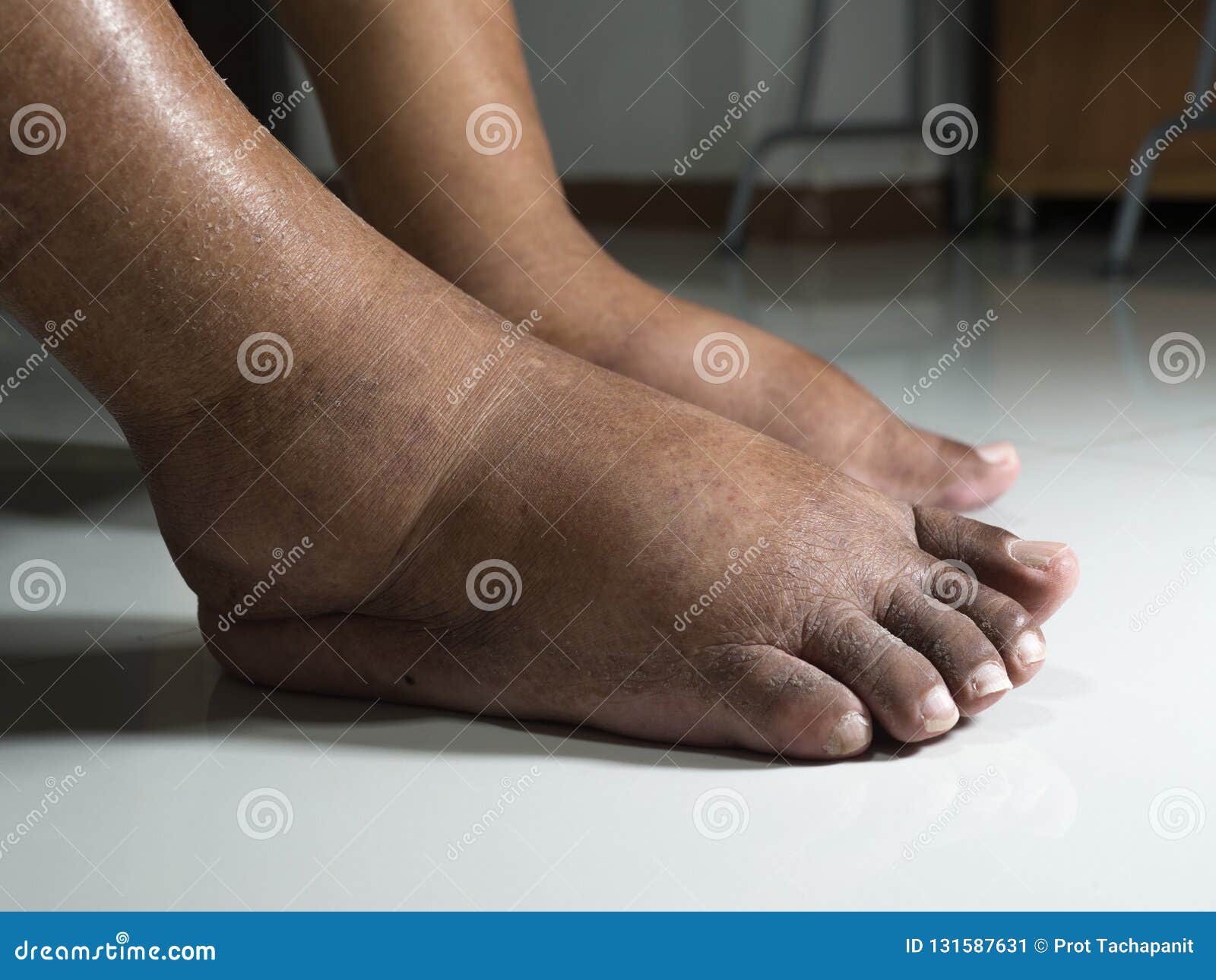 The Feet Of People With Diabetes Dull And Swollen Due To The Toxicity