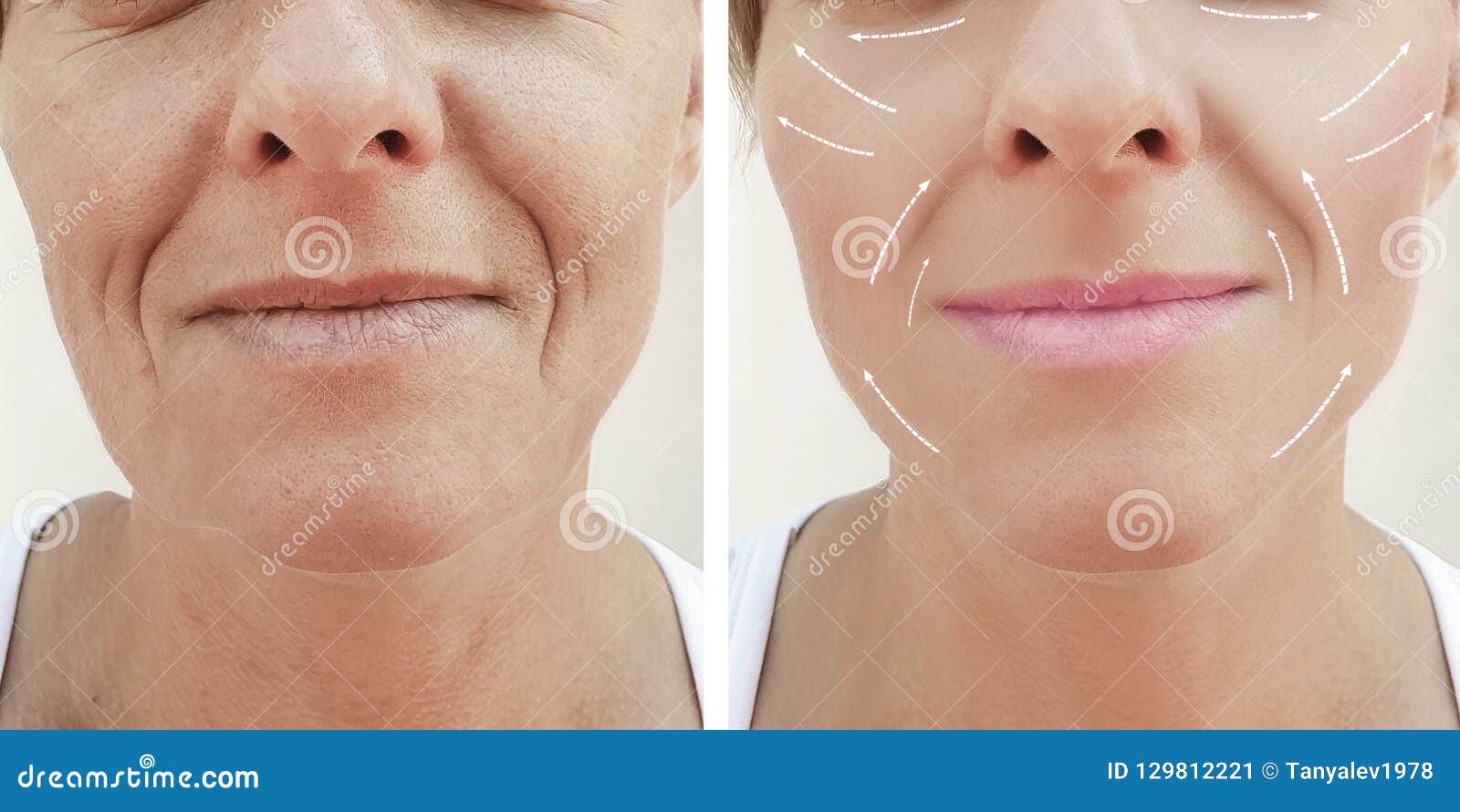 Female Adult Facial Wrinkles Rejuvenation Filler Mature Patient