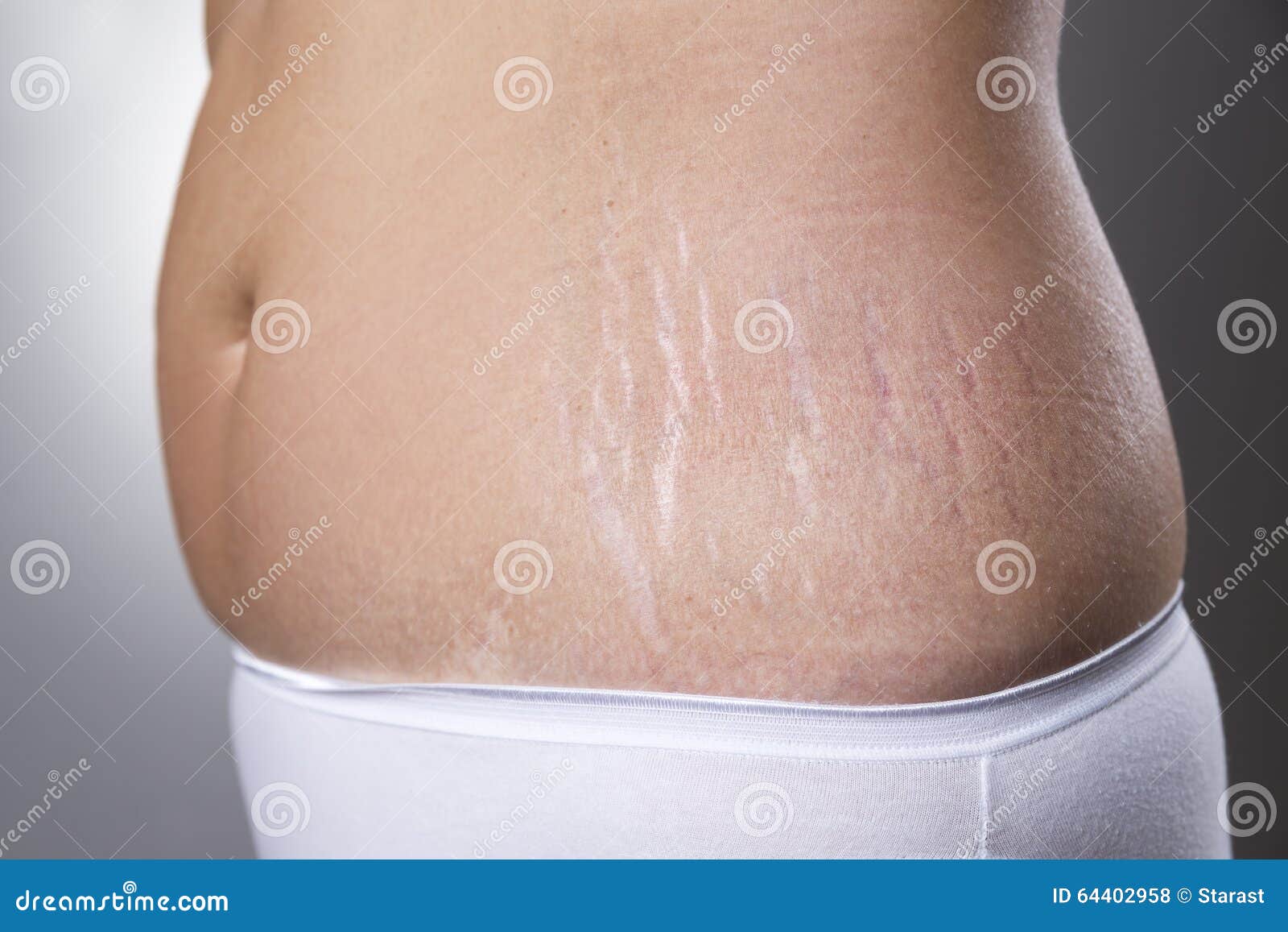 female belly with pregnancy stretch marks closeup