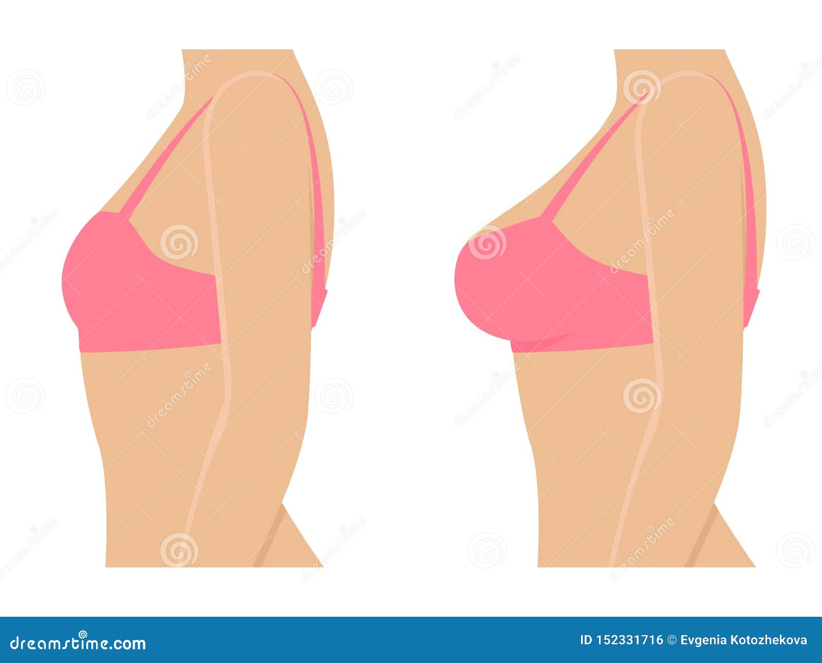 Breast Size Bust Enlargement Implant Plastic Surgery Stock Vector