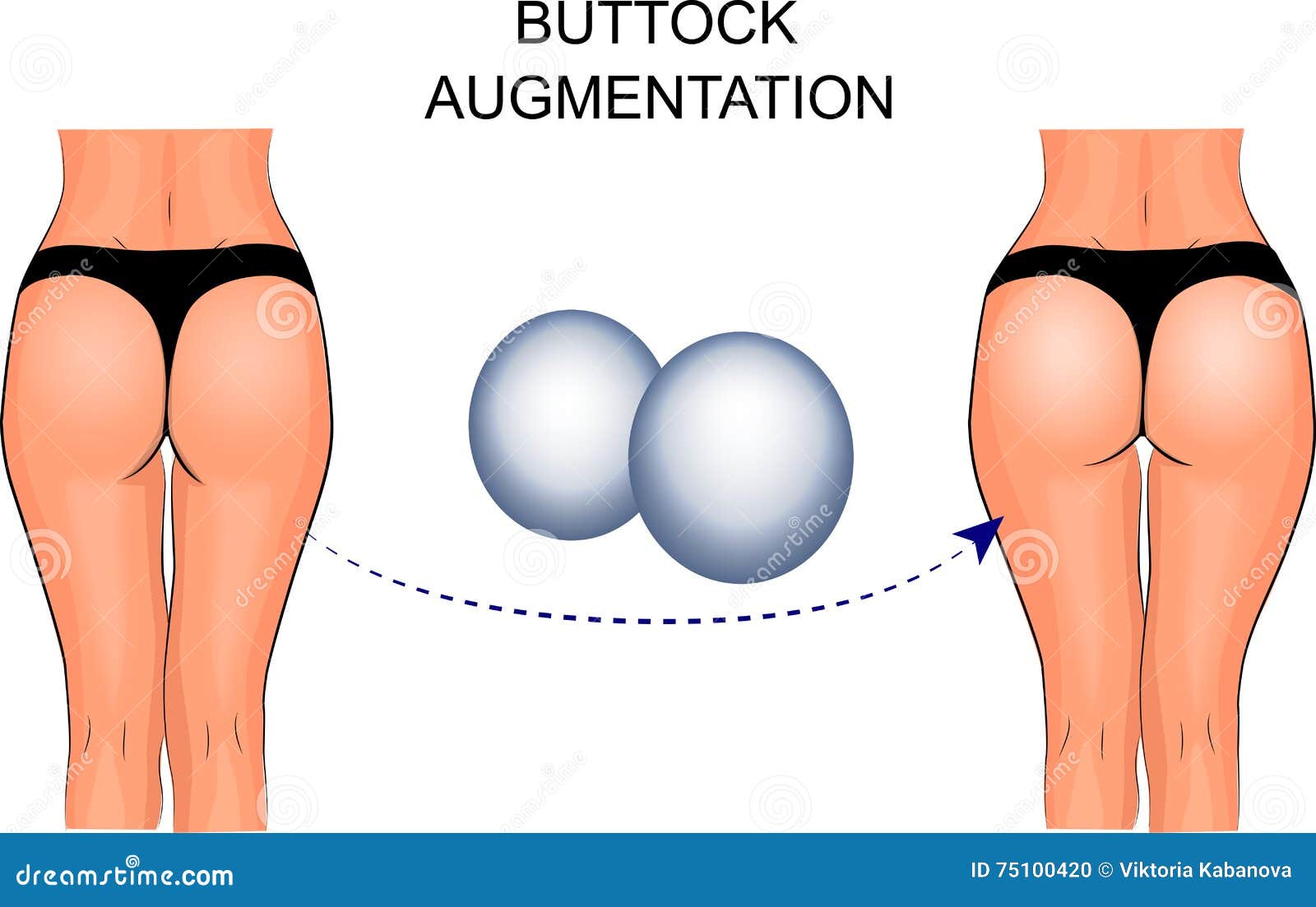 Buttock Augmentation Typography Word Cloud Create With The Text Only