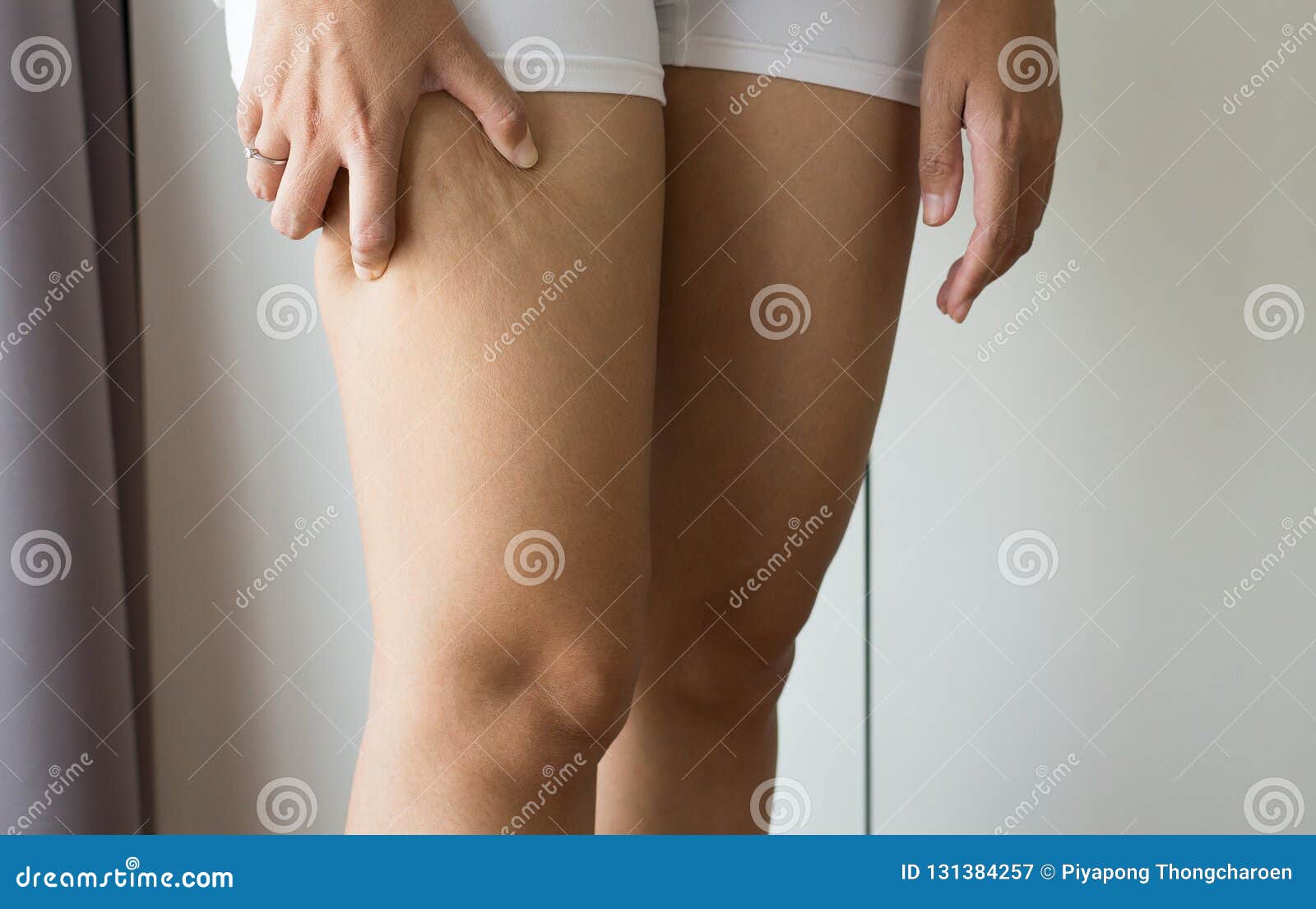 woman with cellulitis on leg excess and overweight fatty of female