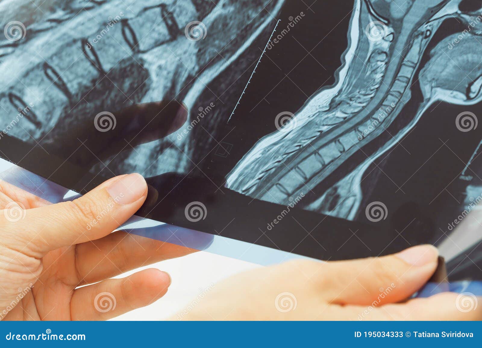 female doctors hand pointing at x-ray medical imaging at a shoulder condition