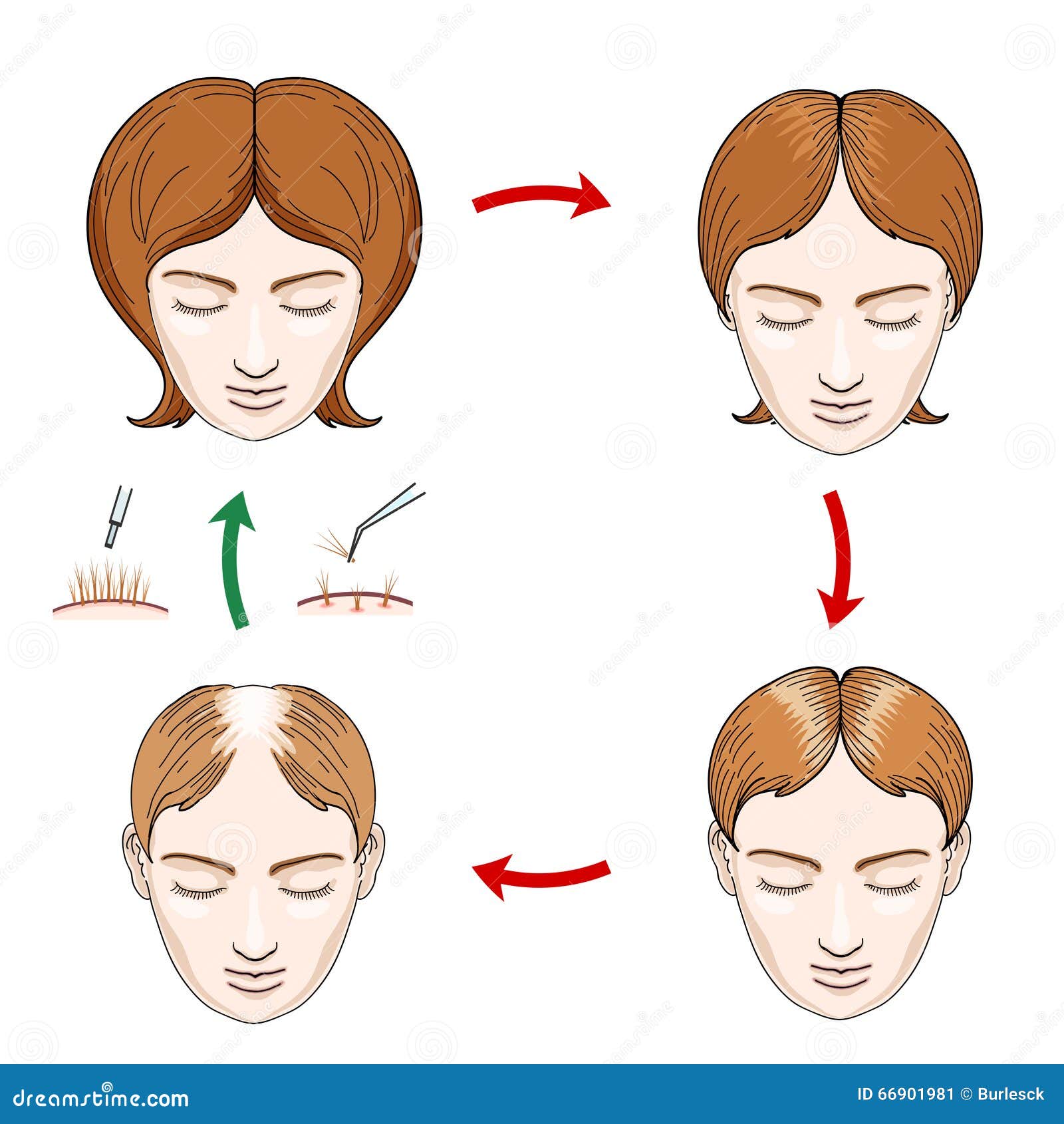 female hair loss and transplantation icons