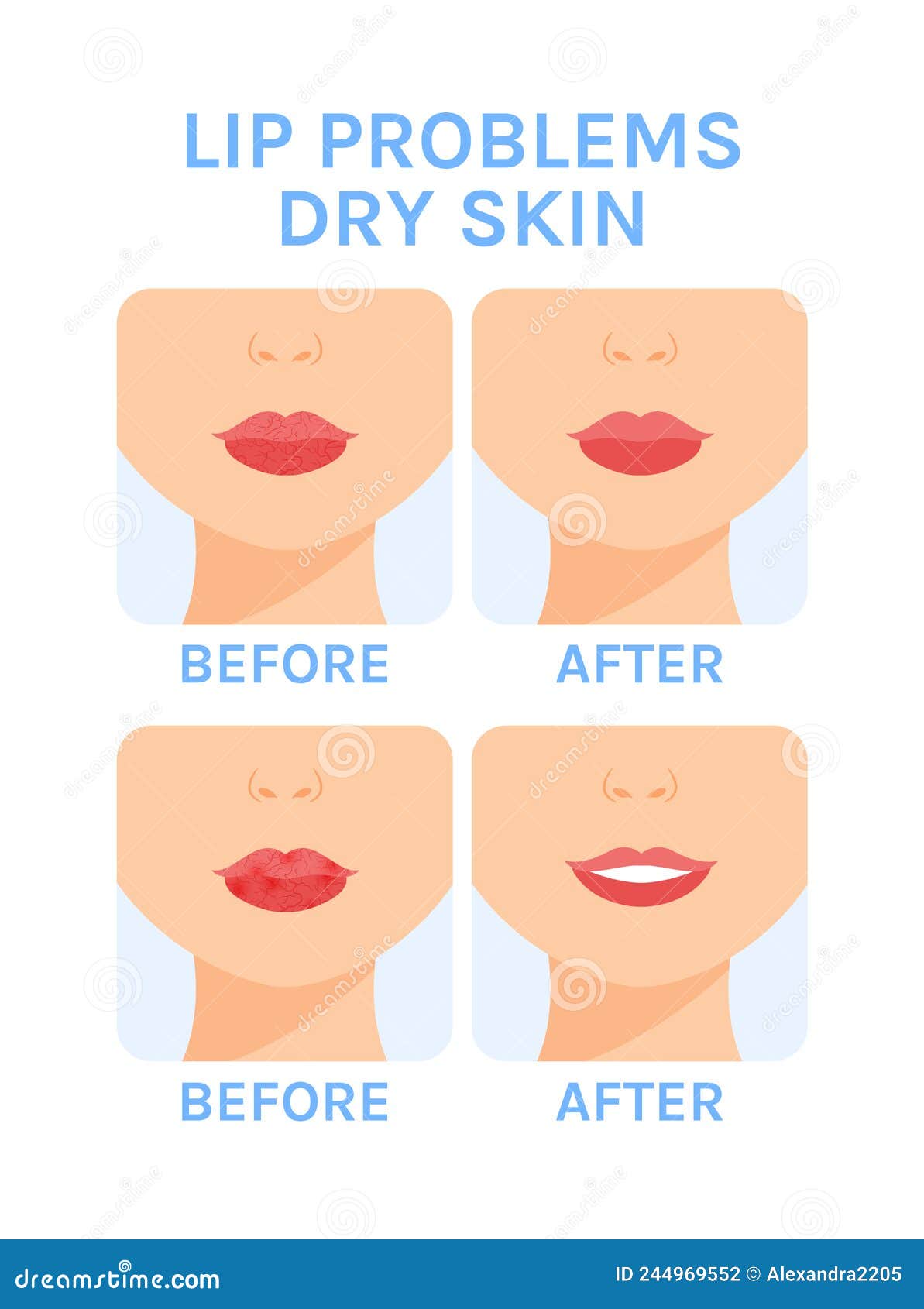 Dry Lips Before And After Cliparts, Stock Vector and Royalty Free Dry Lips  Before And After Illustrations