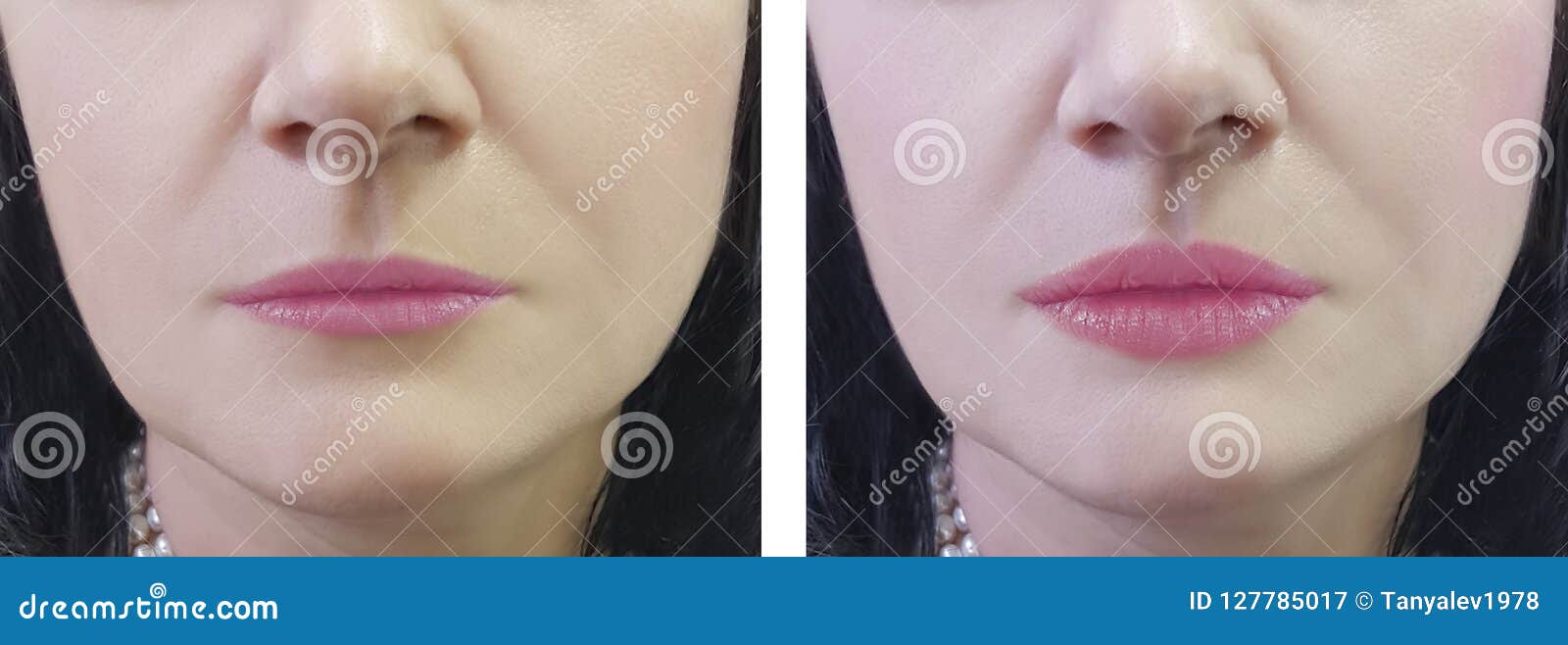 Female Lips Increase before and after the Procedure Stock Image Image of fashion, increase