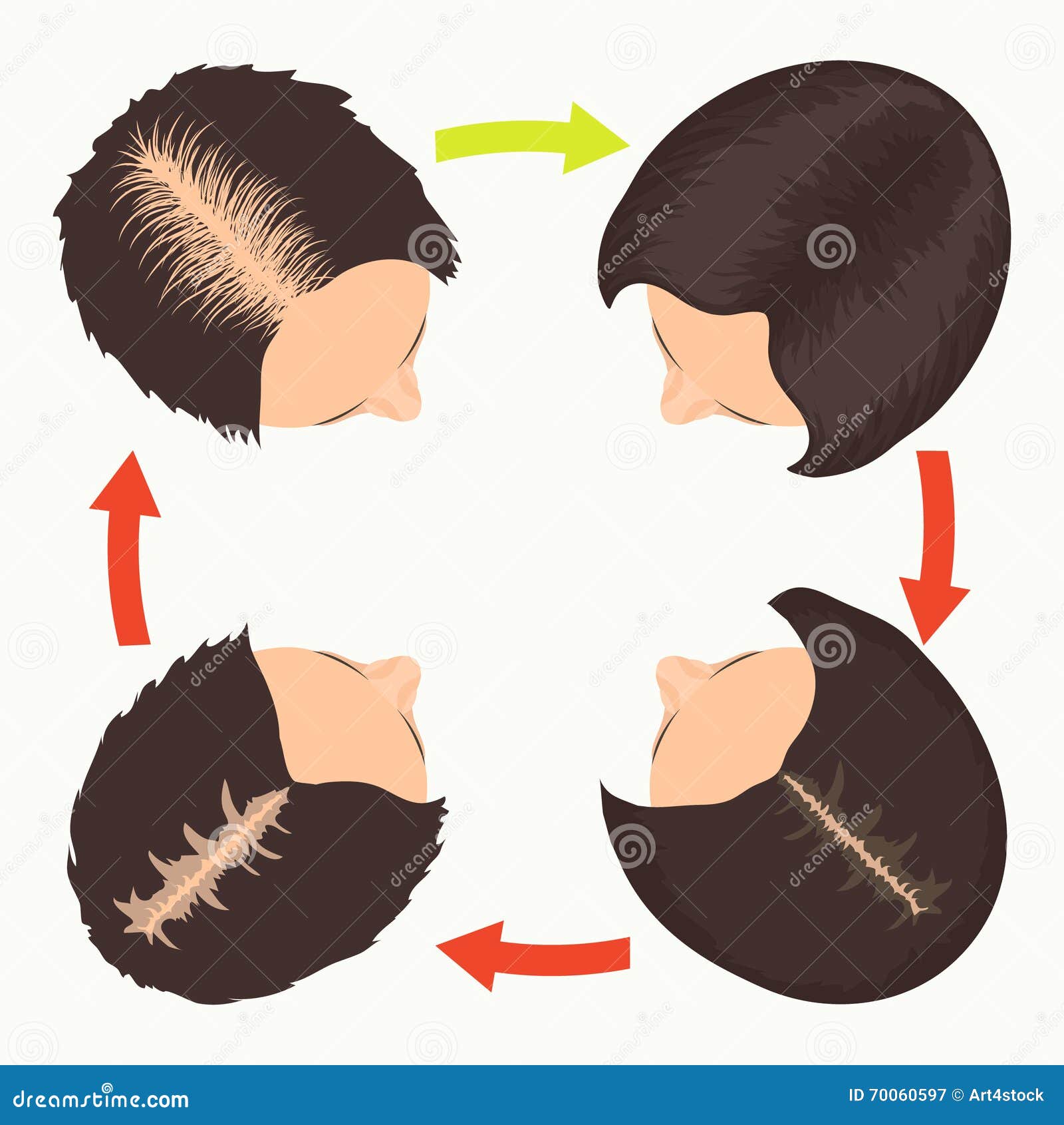 Female Pattern Hair Loss Stages Stock Vector - Illustration of hairless,  implantation: 70060597