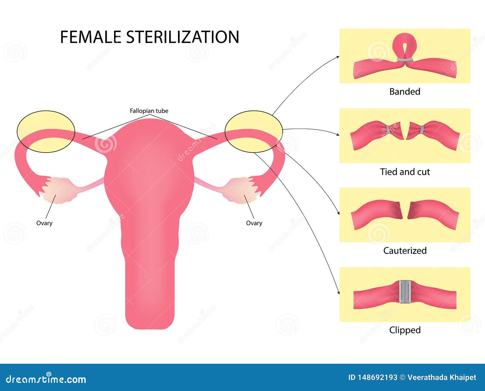 Female Sterilization, Tubal Ligation Stock Illustration - Illustration