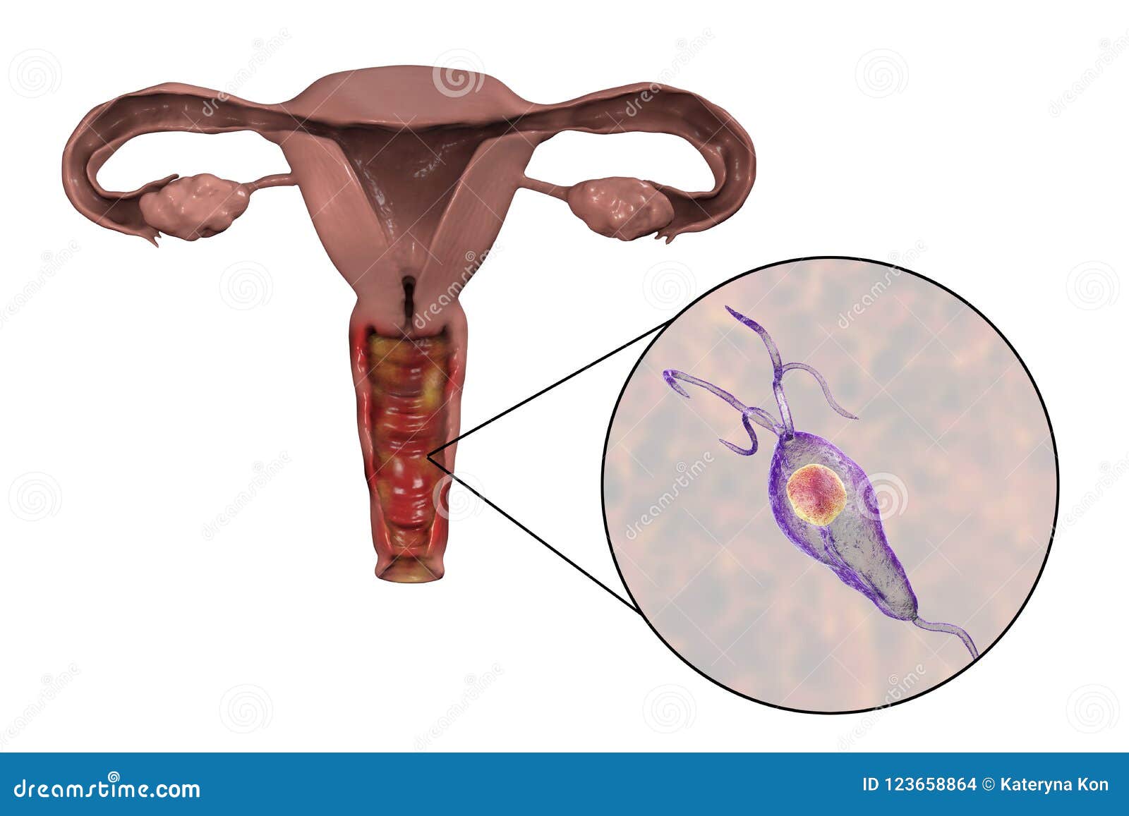 trichomonas trichomoniasis paraziták az emberi testben a test tisztításával
