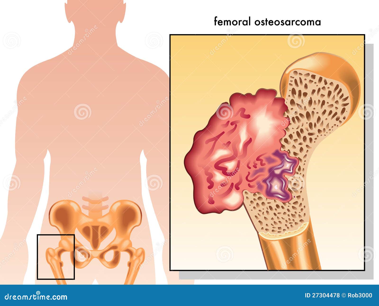 femoral osteosarcoma