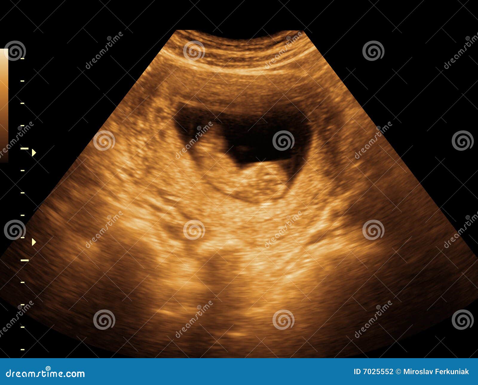 fetus ultrasound